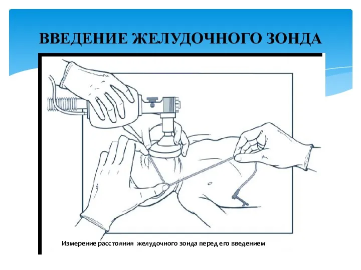 ВВЕДЕНИЕ ЖЕЛУДОЧНОГО ЗОНДА Измерение расстояния желудочного зонда перед его введением