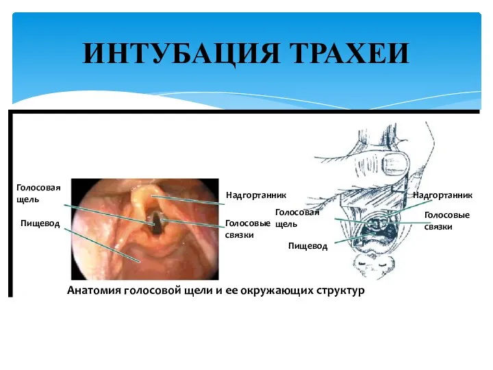 ИНТУБАЦИЯ ТРАХЕИ