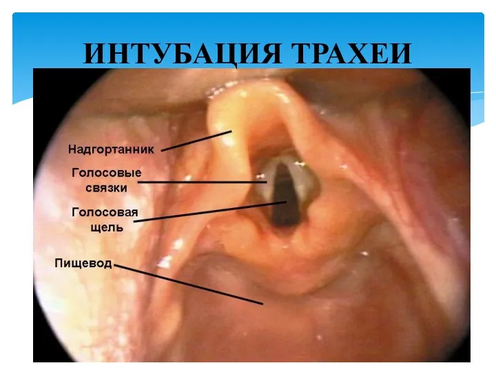 ИНТУБАЦИЯ ТРАХЕИ