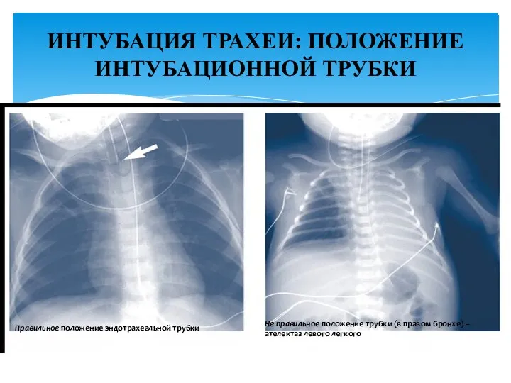 Правильное положение эндотрахеальной трубки Не правильное положение трубки (в правом