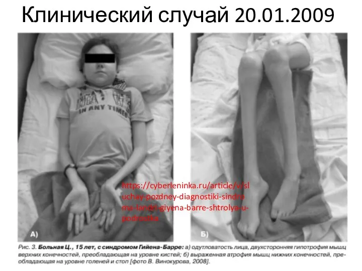 Клинический случай 20.01.2009 https://cyberleninka.ru/article/v/sluchay-pozdney-diagnostiki-sindroma-landri-giyena-barre-shtrolya-u-podrostka