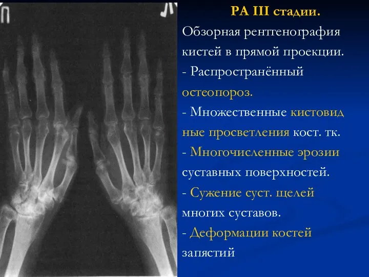 РА III стадии. Обзорная рентгенография кистей в прямой проекции. - Распространённый остеопороз. -