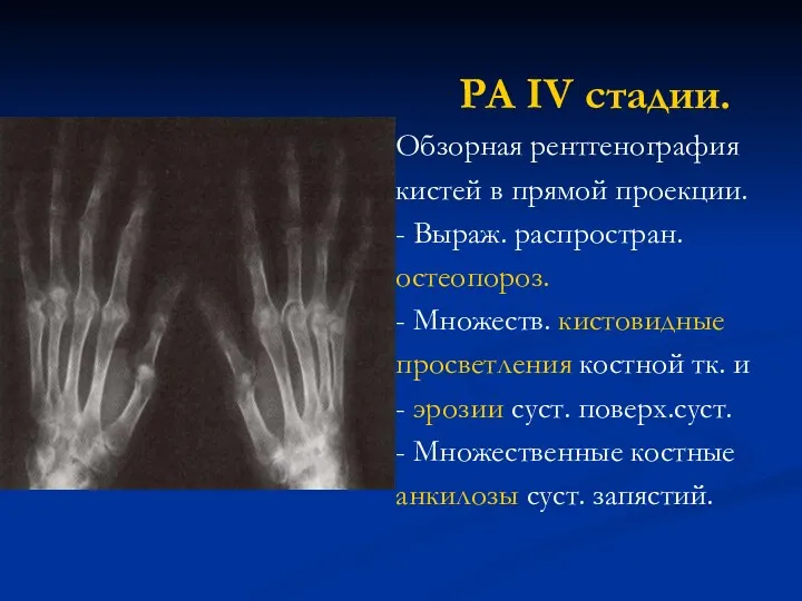 РА IV стадии. Обзорная рентгенография кистей в прямой проекции. - Выраж. распростран. остеопороз.