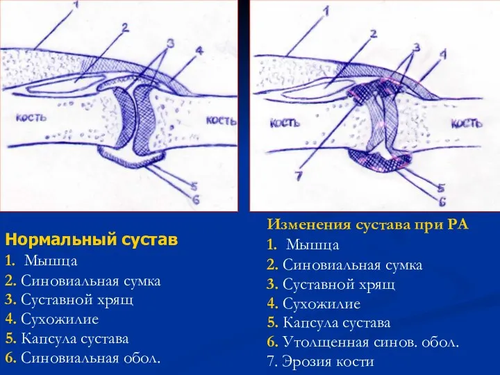 Нормальный сустав 1. Мышца 2. Синовиальная сумка 3. Суставной хрящ 4. Сухожилие 5.