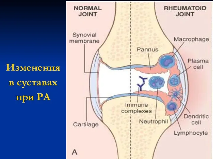 Изменения в суставах при РА