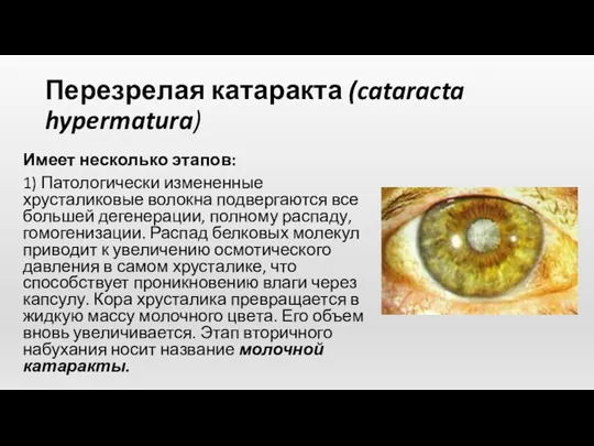 Перезрелая катаракта (cataracta hypermatura) Имеет несколько этапов: 1) Патологически измененные