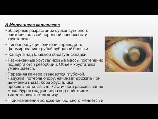 2) Морганиева катаракта обширные разрастания субкапсулярного эпителия по всей передней поверхности хрусталика. Гиперпродукция