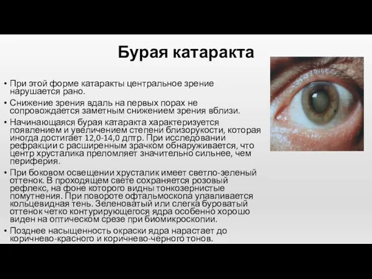 Бурая катаракта При этой форме катаракты центральное зрение нарушается рано.