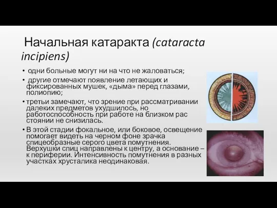 Начальная катаракта (cataracta incipiens) одни больные могут ни на что не жаловаться; другие