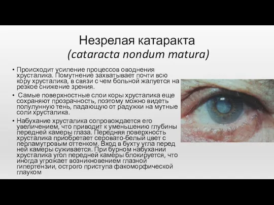 Незрелая катаракта (cataracta nondum matura) Происходит усиление процессов оводнения хрусталика. Помутнение захватывает почти
