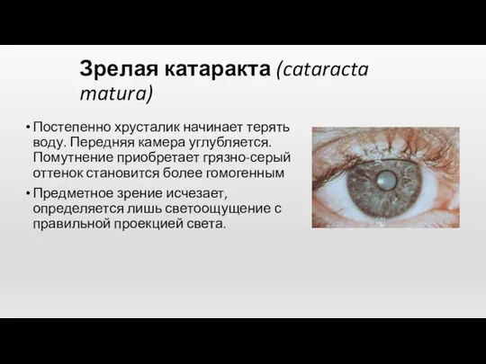 Зрелая катаракта (cataracta matura) Постепенно хрусталик начинает терять воду. Передняя камера углубляется. Помутнение
