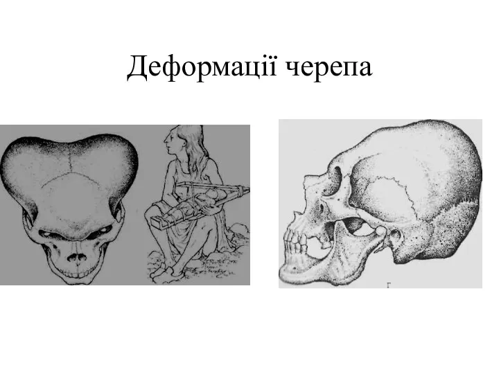 Деформації черепа