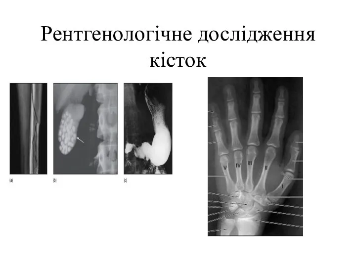 Рентгенологічне дослідження кісток