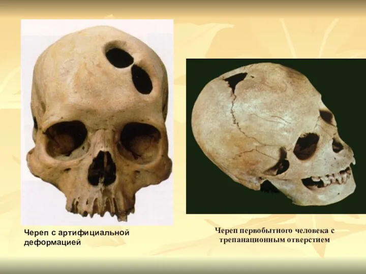 Череп с артифициальной деформацией Череп первобытного человека с трепанационным отверстием