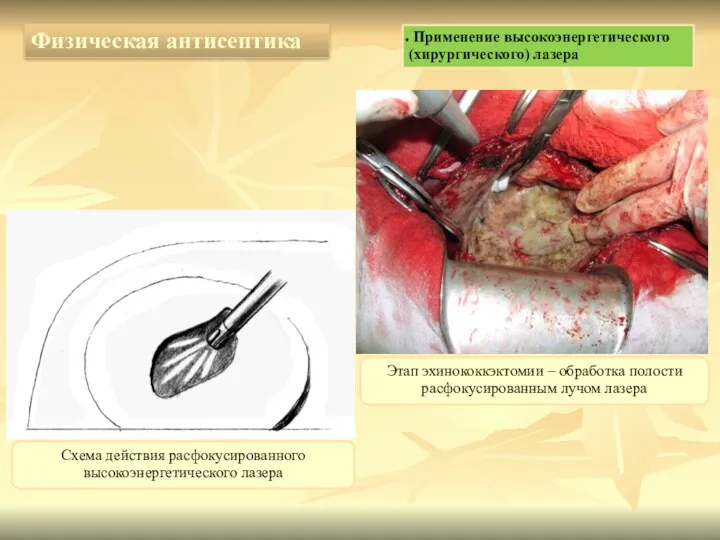 Этап эхинококкэктомии – обработка полости расфокусированным лучом лазера Физическая антисептика