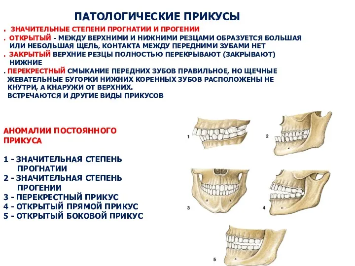 ПАТОЛОГИЧЕСКИЕ ПРИКУСЫ . ЗНАЧИТЕЛЬНЫЕ СТЕПЕНИ ПРОГНАТИИ И ПРОГЕНИИ . ОТКРЫТЫЙ