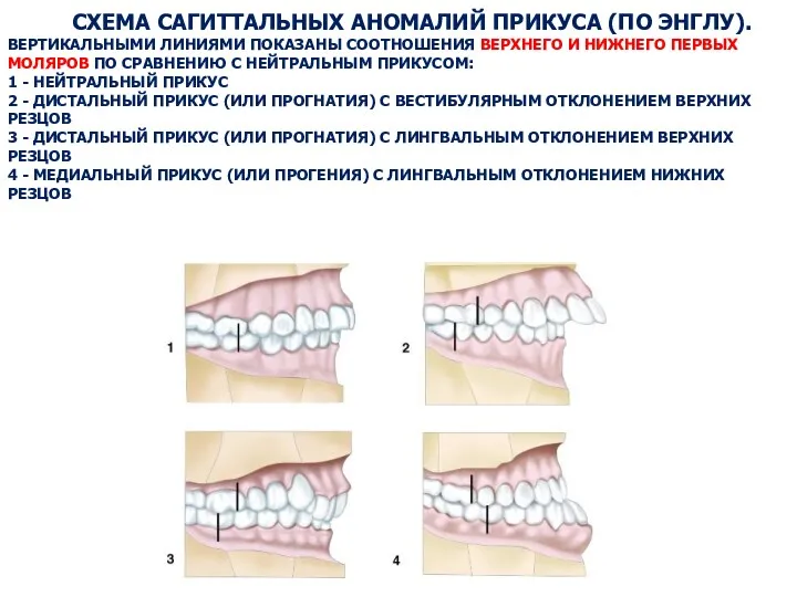 СХЕМА САГИТТАЛЬНЫХ АНОМАЛИЙ ПРИКУСА (ПО ЭНГЛУ). ВЕРТИКАЛЬНЫМИ ЛИНИЯМИ ПОКАЗАНЫ СООТНОШЕНИЯ