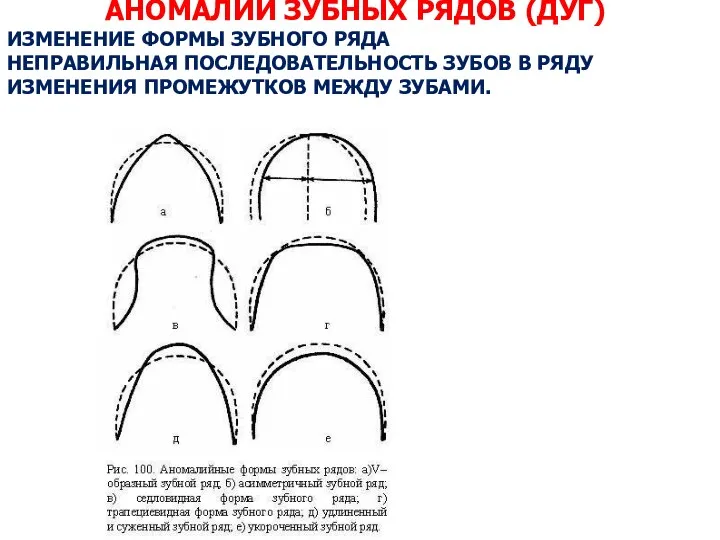 АНОМАЛИИ ЗУБНЫХ РЯДОВ (ДУГ) ИЗМЕНЕНИЕ ФОРМЫ ЗУБНОГО РЯДА НЕПРАВИЛЬНАЯ ПОСЛЕДОВАТЕЛЬНОСТЬ