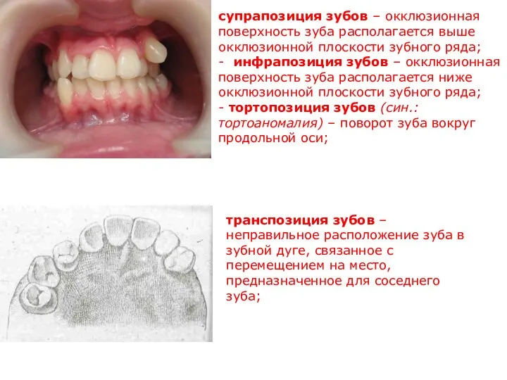 супрапозиция зубов – окклюзионная поверхность зуба располагается выше окклюзионной плоскости