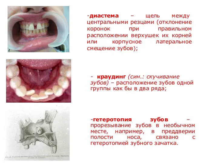 -диастема – щель между центральными резцами (отклонение коронок при правильном