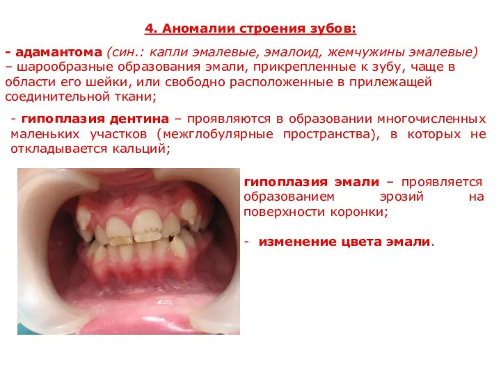 4. Аномалии строения зубов: - адамантома (син.: капли эмалевые, эмалоид,