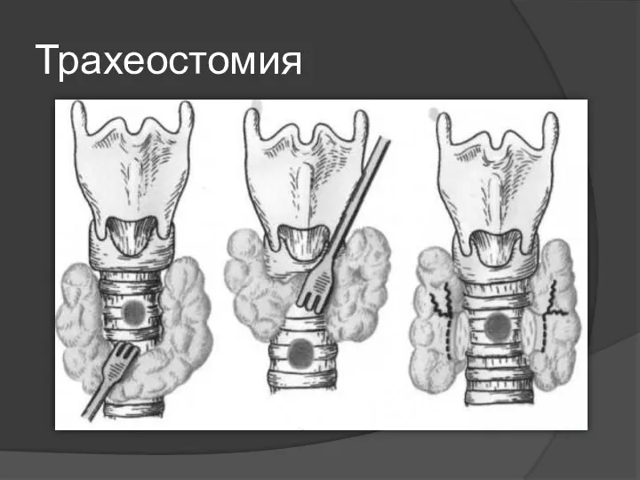 Трахеостомия