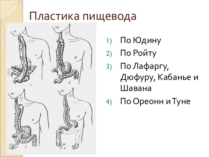 Пластика пищевода По Юдину По Ройту По Лафаргу, Дюфуру, Кабанье и Шавана По Ореонн и Туне