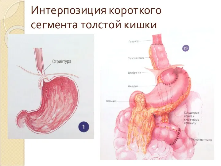 Интерпозиция короткого сегмента толстой кишки