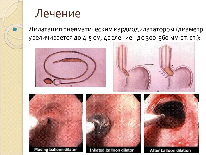 Лечение Дилатация пневматическим кардиодилататором (диаметр увеличивается до 4-5 см, давление - до 300-360 мм рт. ст.):