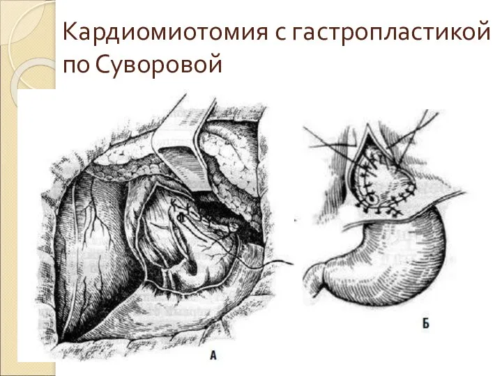 Кардиомиотомия с гастропластикой по Суворовой