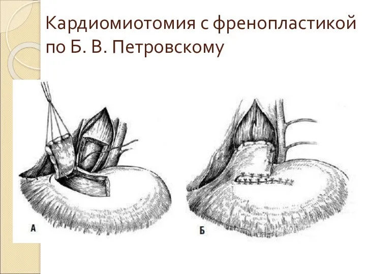 Кардиомиотомия с френопластикой по Б. В. Петровскому