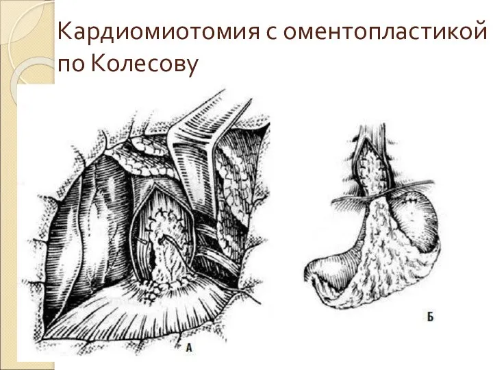 Кардиомиотомия с оментопластикой по Колесову