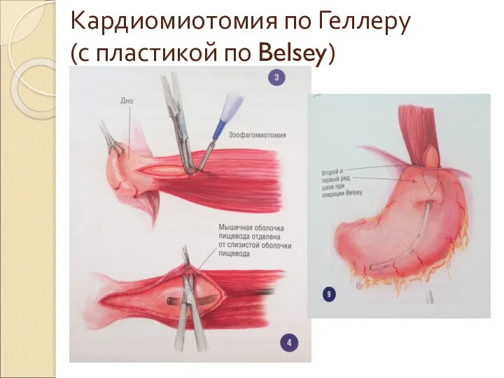 Кардиомиотомия по Геллеру (с пластикой по Belsey)