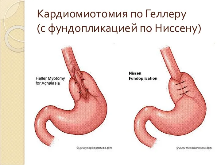 Кардиомиотомия по Геллеру (с фундопликацией по Ниссену)