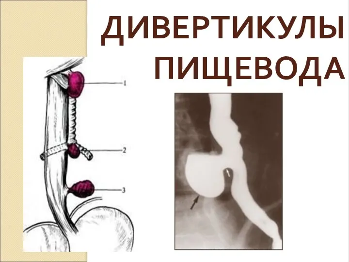 ДИВЕРТИКУЛЫ ПИЩЕВОДА