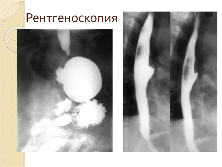 Рентгеноскопия