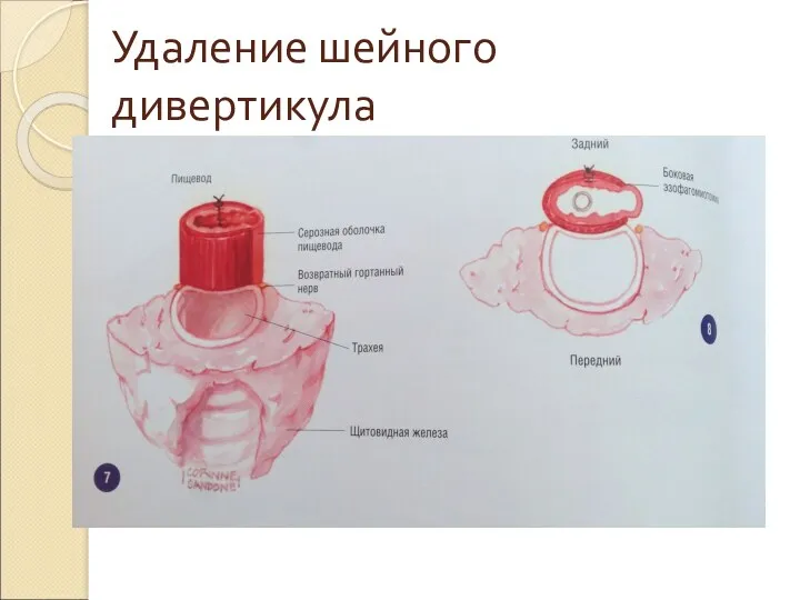 Удаление шейного дивертикула