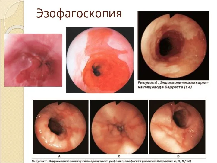 Эзофагоскопия