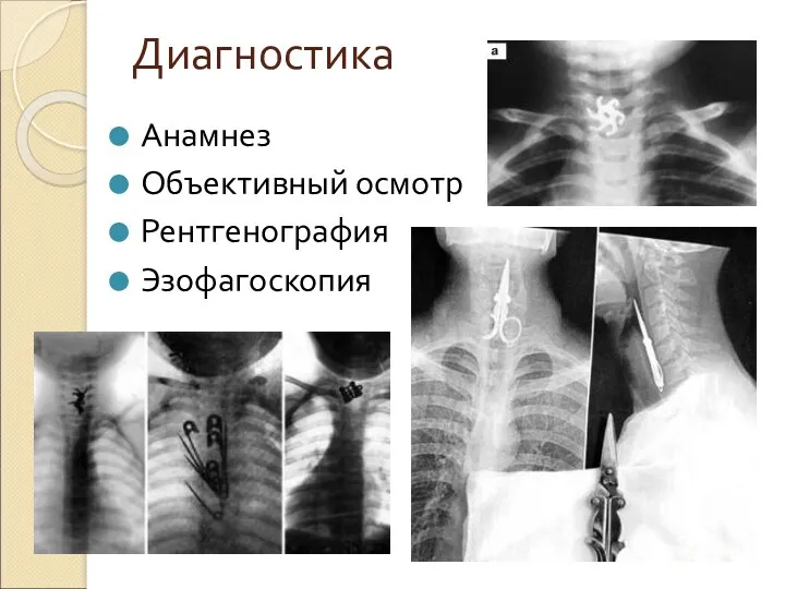 Диагностика Анамнез Объективный осмотр Рентгенография Эзофагоскопия