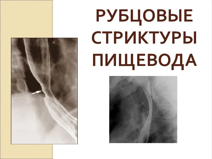 РУБЦОВЫЕ СТРИКТУРЫ ПИЩЕВОДА