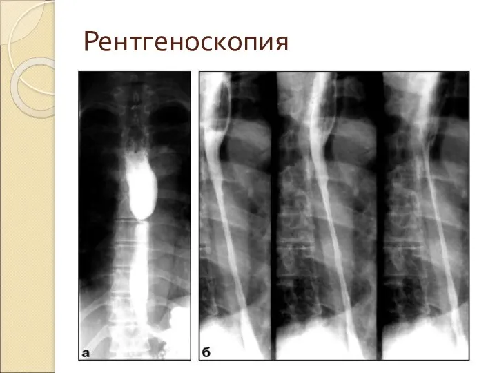 Рентгеноскопия