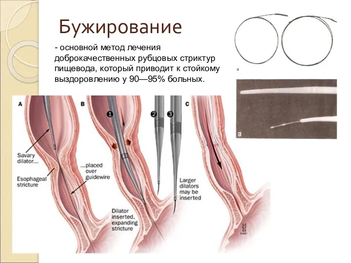 Бужирование - основной метод лечения доброкачественных рубцовых стриктур пищевода, который