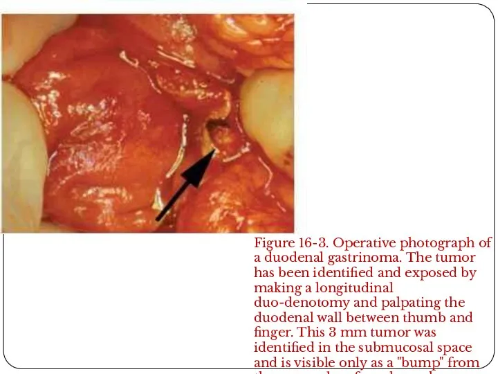 Figure 16-3. Operative photograph of a duodenal gastrinoma. The tumor