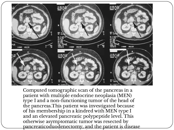 Computed tomographic scan of the pancreas in a patient with