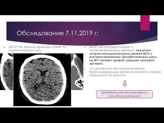 Обследование 7.11.2019 г: МСКТ ГМ: ранние признаки ОНМК по ишемическому