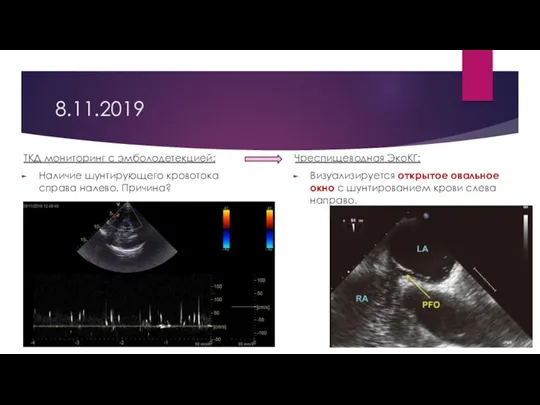 8.11.2019 ТКД мониторинг с эмболодетекцией: Наличие шунтирующего кровотока справа налево.