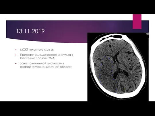 13.11.2019 МСКТ головного мозга: Признаки ишемического инсульта в бассейне правой