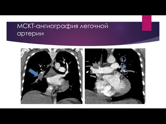 МСКТ-ангиография легочной артерии