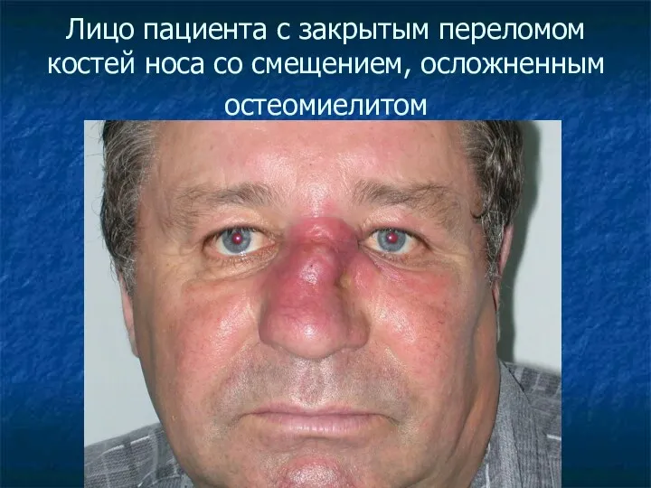Лицо пациента с закрытым переломом костей носа со смещением, осложненным остеомиелитом