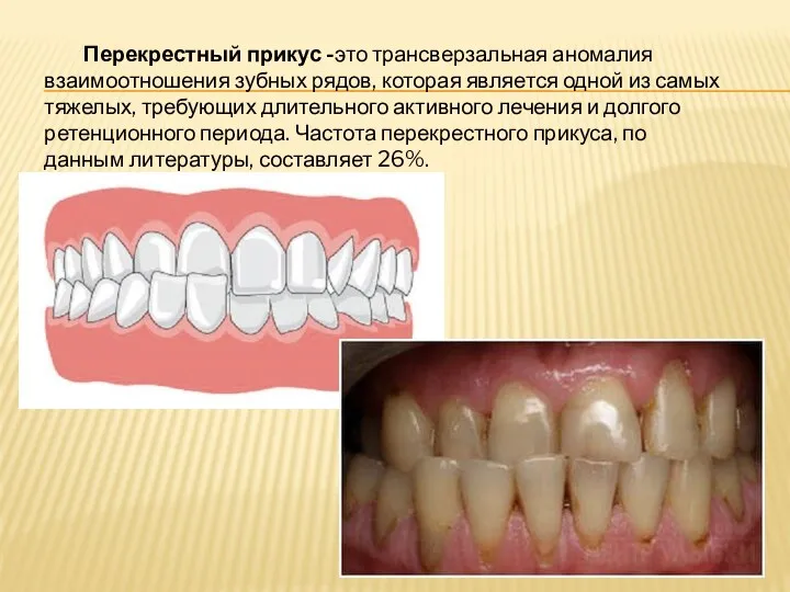 Перекрестный прикус -это трансверзальная аномалия взаимоотношения зубных рядов, которая является одной из самых
